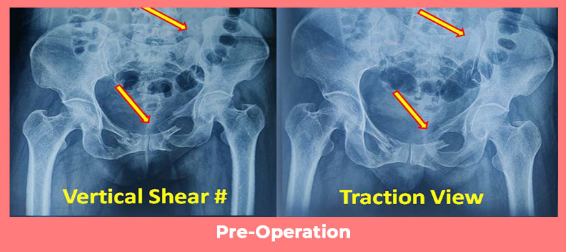 Frontiers | Clinical and Patient-Related Outcome After Stabilization of  Dorsal Pelvic Ring Fractures: A Retrospective Study Comparing Transiliac  Fixator (TIFI) and Spinopelvic Fixation (SPF)
