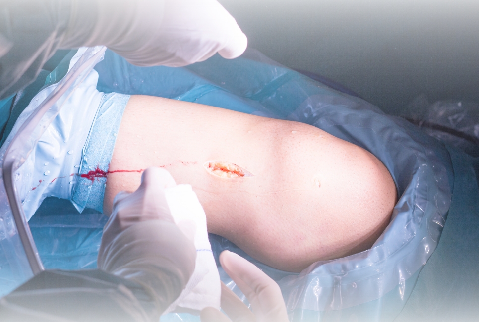 How does traditional Orthopaedic surgery differ from Arthroscopy Surgery in Delhi?